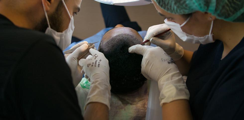 Giga Session Hair Transplant