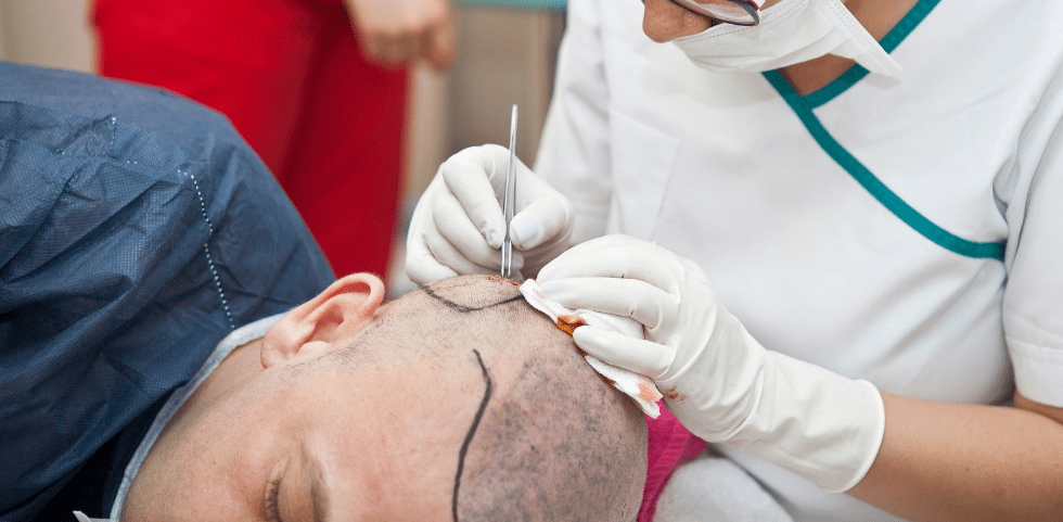 Hair Transplant treatment