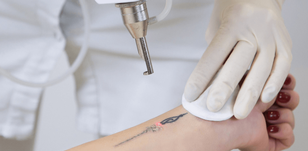 laser tattoo removal