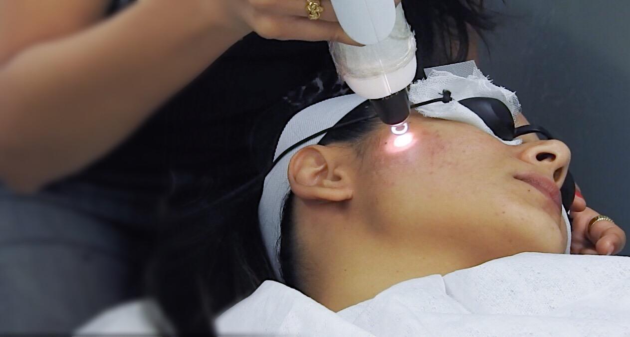 Q-Switch-Laser-Treatment-at-About-Face-Mumbai-Review