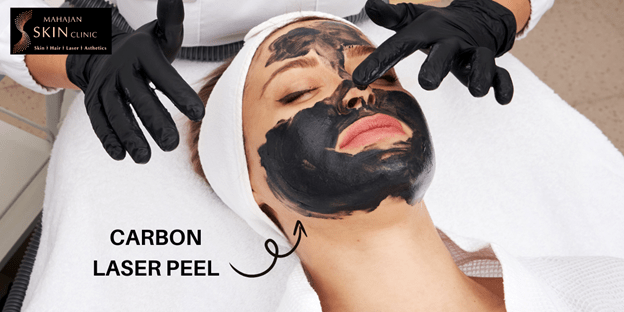 Carbon laser Facial Cost in Delhi