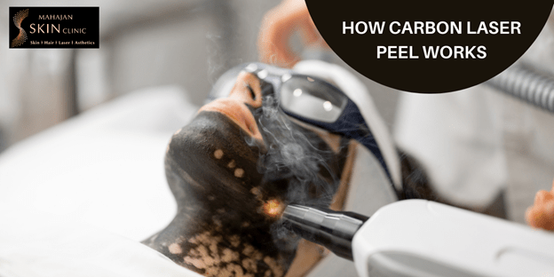 Carbon laser Facial Cost in Delhi 2