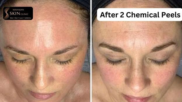 How to Choose the Right Chemical Peel Treatment