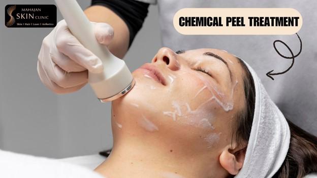 How to Choose the Right Chemical Peel Treatment