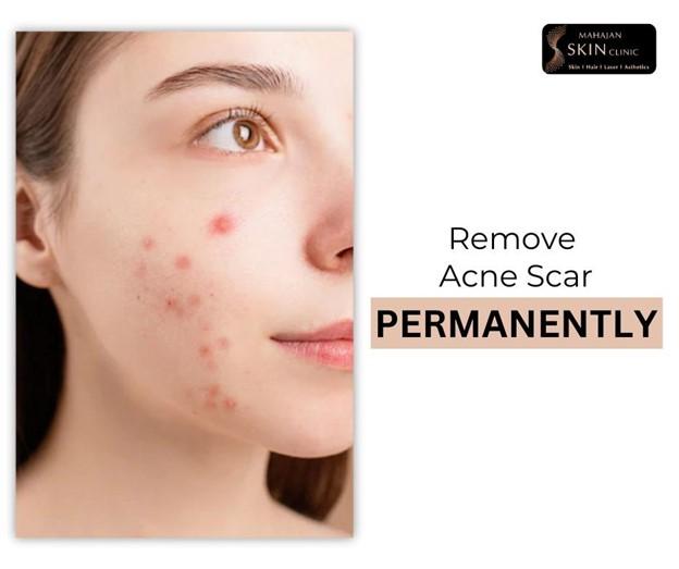 Top Acne Treatments Recommended by Dermatologists