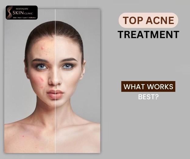 Top Acne Treatments Recommended by Dermatologists